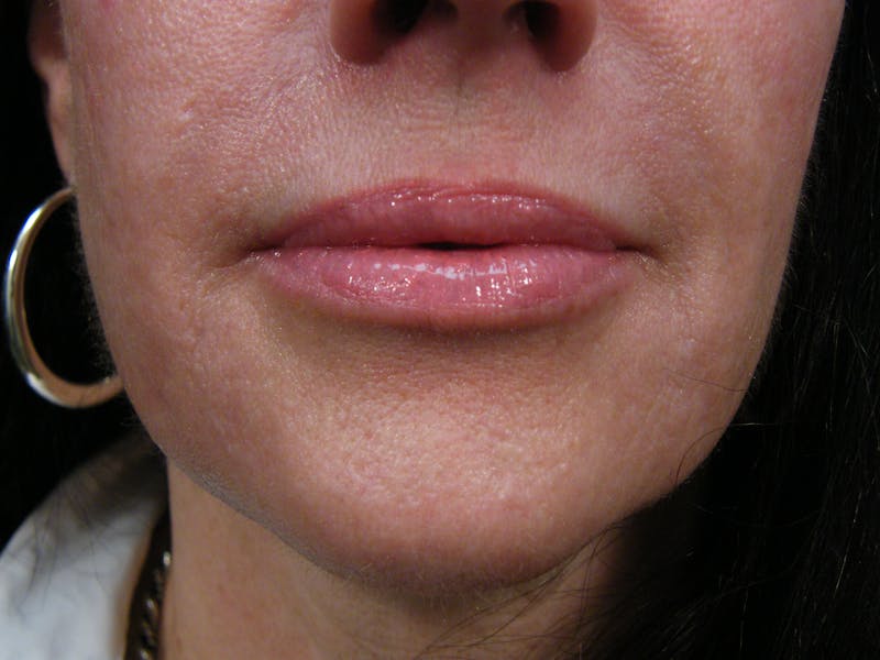 Liquid Facelift & Botunlinum Before & After Gallery - Patient 185270 - Image 2