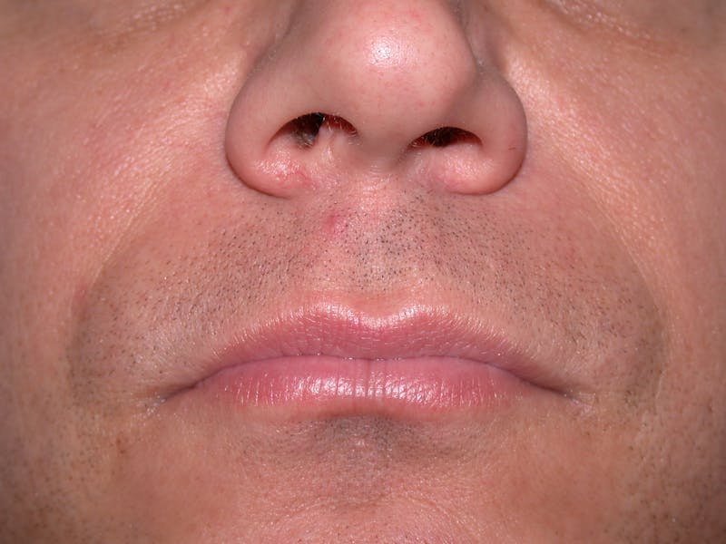Liquid Facelift & Botunlinum Before & After Gallery - Patient 420066 - Image 1