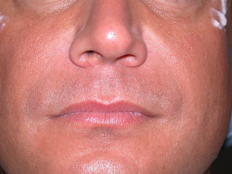 Liquid Facelift & Botunlinum Before & After Gallery - Patient 420066 - Image 2