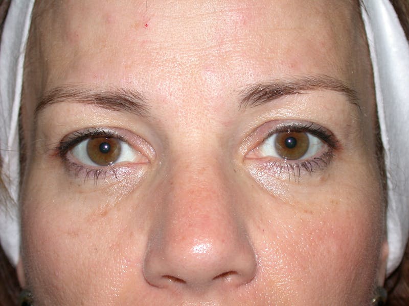 Liquid Facelift & Botunlinum Before & After Gallery - Patient 141003 - Image 1