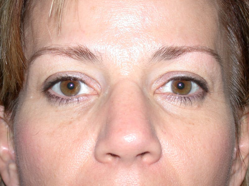 Liquid Facelift & Botunlinum Before & After Gallery - Patient 141003 - Image 2