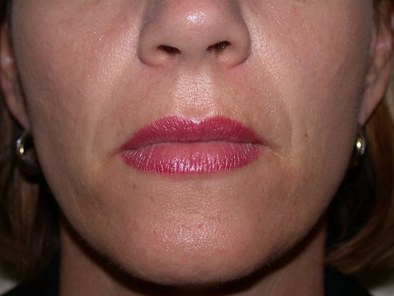 Liquid Facelift & Botunlinum Before & After Gallery - Patient 141003 - Image 3