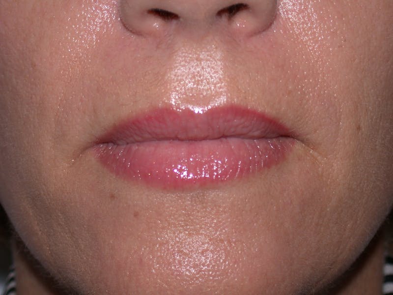 Liquid Facelift & Botunlinum Before & After Gallery - Patient 141003 - Image 4