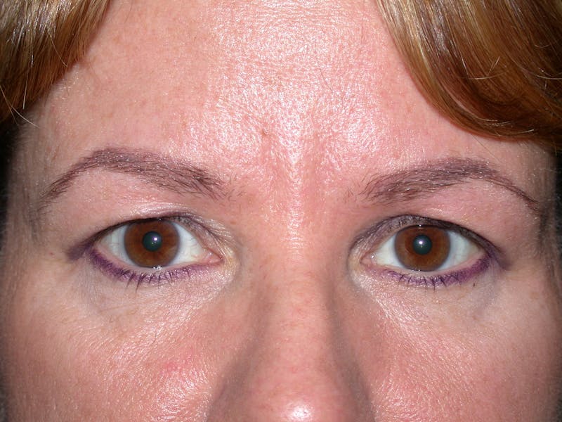 Liquid Facelift & Botunlinum Before & After Gallery - Patient 354566 - Image 1