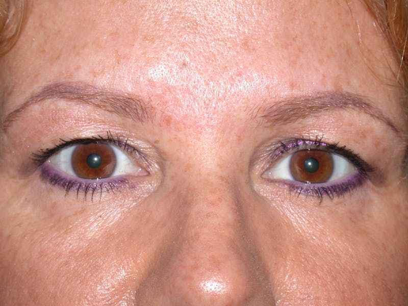 Liquid Facelift & Botunlinum Before & After Gallery - Patient 354566 - Image 2
