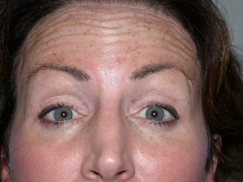 Liquid Facelift & Botunlinum Before & After Gallery - Patient 413422 - Image 1