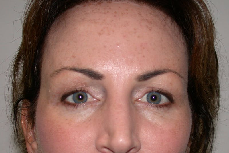 Liquid Facelift & Botunlinum Before & After Gallery - Patient 413422 - Image 2