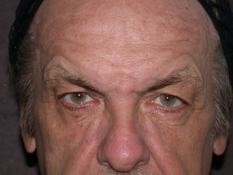 Liquid Facelift & Botunlinum Before & After Gallery - Patient 930884 - Image 1