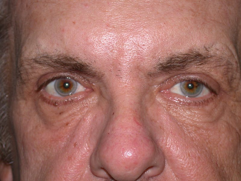 Liquid Facelift & Botunlinum Before & After Gallery - Patient 930884 - Image 2