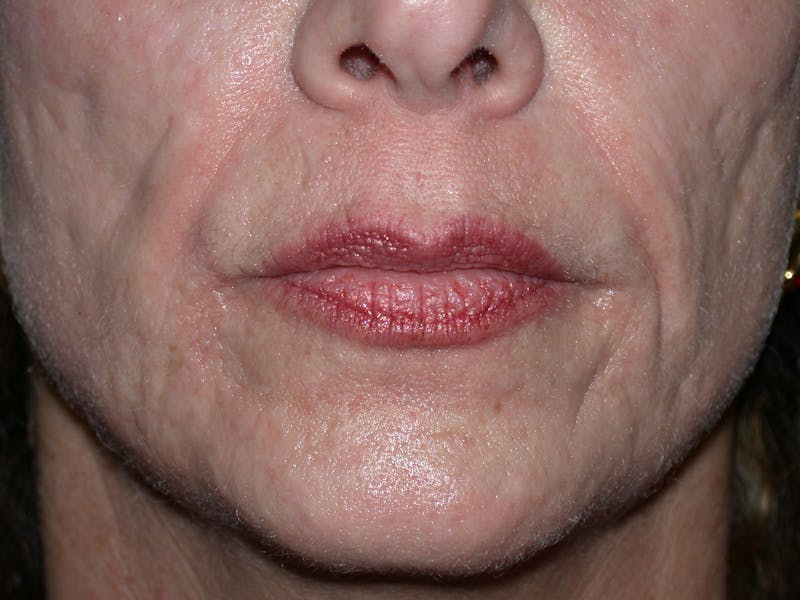 Laser Treatments Before & After Gallery - Patient 833857 - Image 1