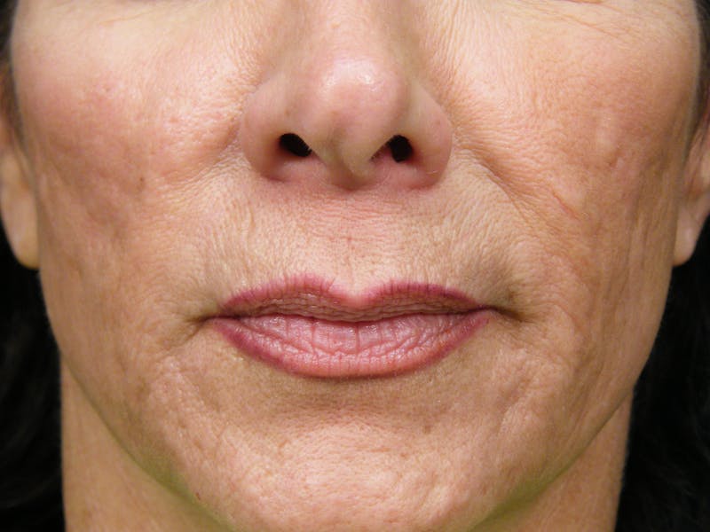 Laser Treatments Before & After Gallery - Patient 833857 - Image 2