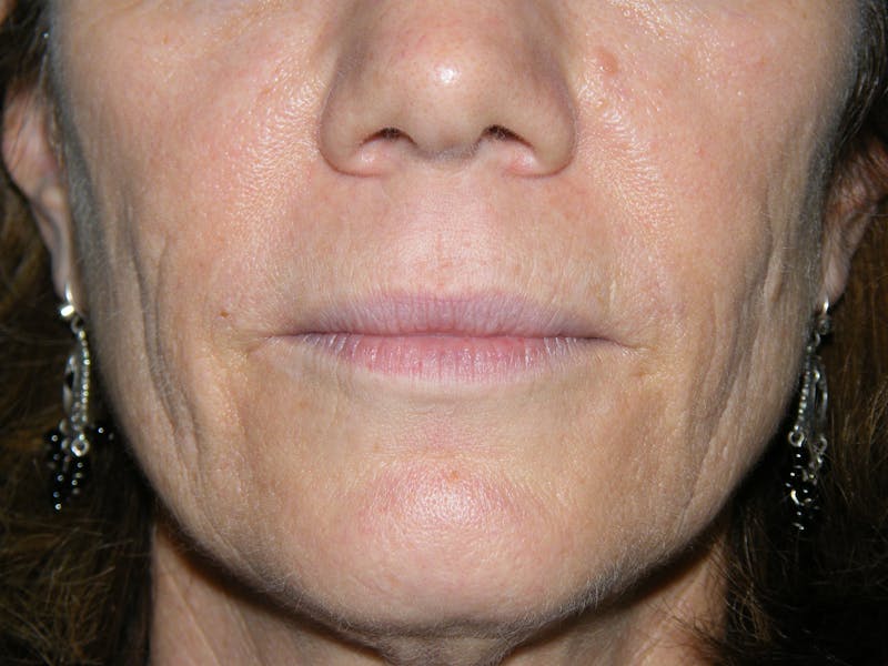 Laser Treatments Before & After Gallery - Patient 208596 - Image 1