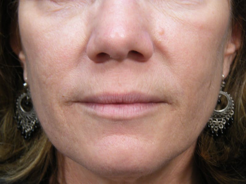 Laser Treatments Before & After Gallery - Patient 208596 - Image 2
