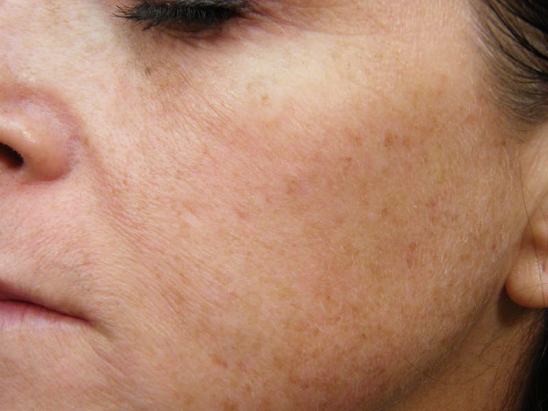 Laser Treatments Before & After Gallery - Patient 802530 - Image 1