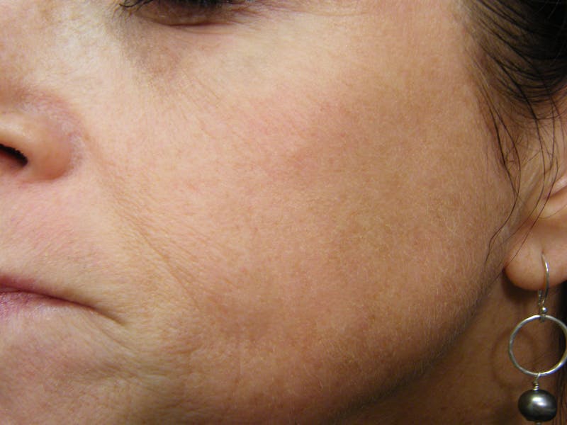 Laser Treatments Before & After Gallery - Patient 802530 - Image 2