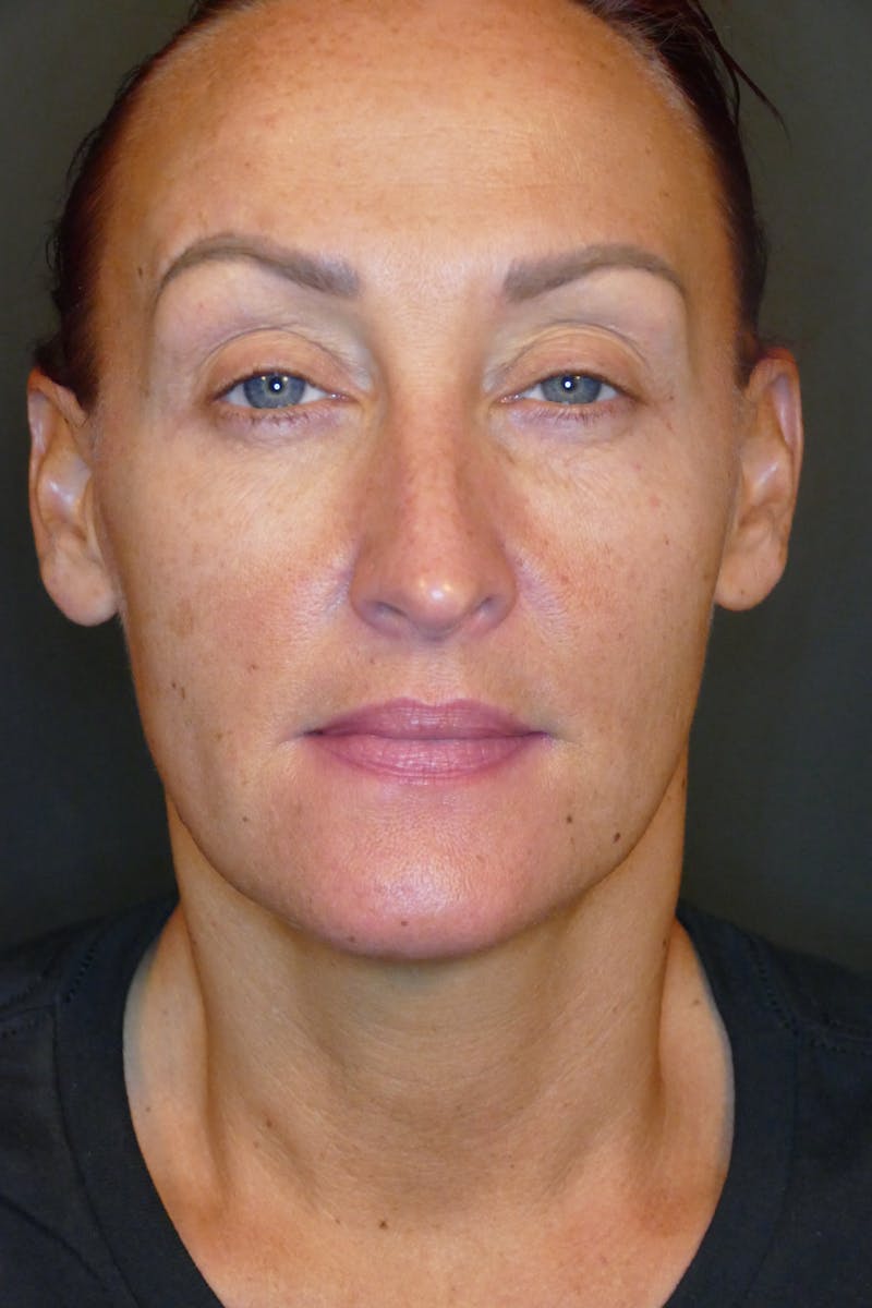 Laser Treatments Before & After Gallery - Patient 423258 - Image 1