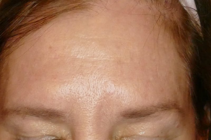 Laser Treatments Before & After Gallery - Patient 234290 - Image 1