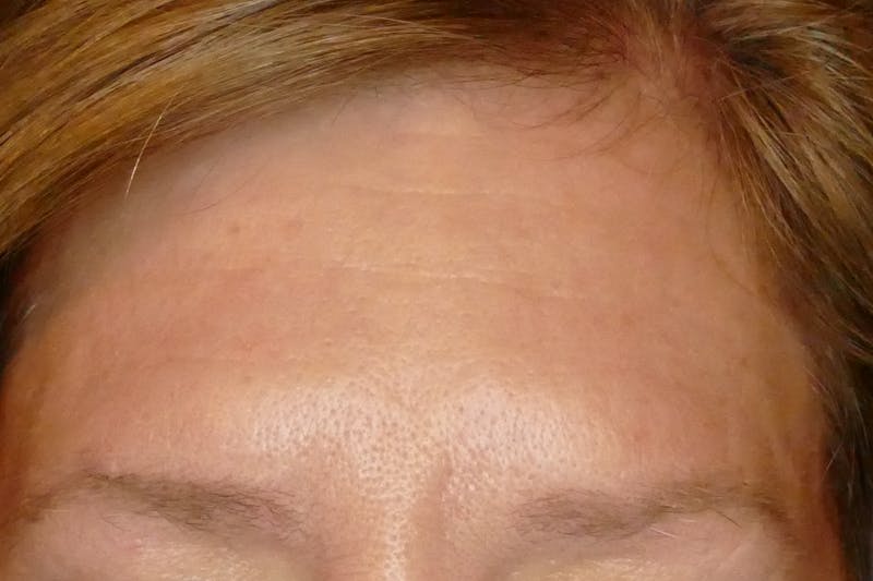 Laser Treatments Before & After Gallery - Patient 234290 - Image 2