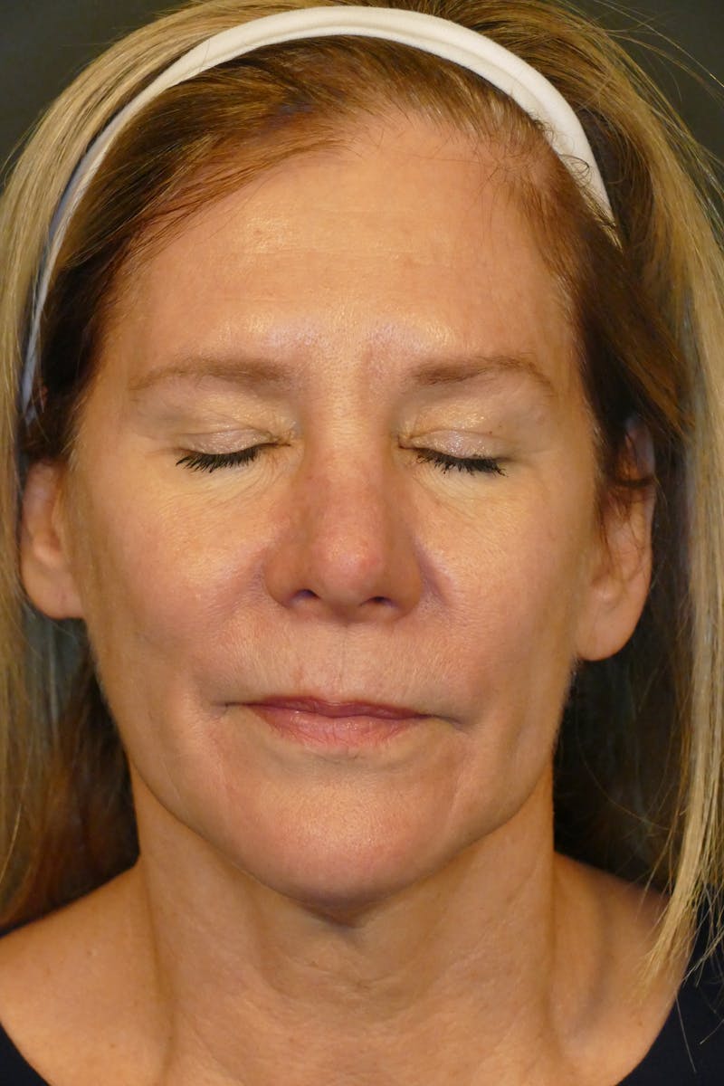 Laser Treatments Before & After Gallery - Patient 234290 - Image 3