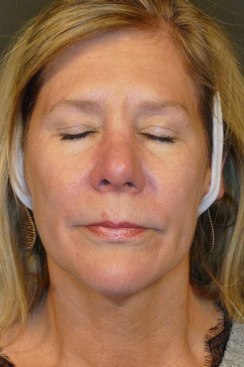 Laser Treatments Before & After Gallery - Patient 234290 - Image 4