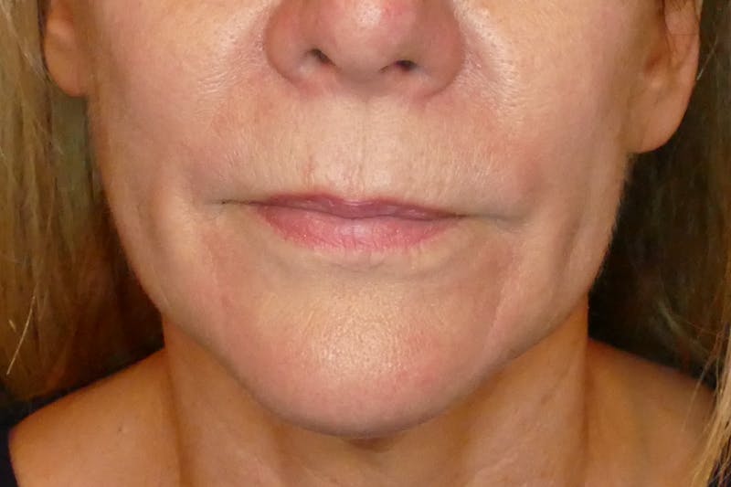 Laser Treatments Before & After Gallery - Patient 234290 - Image 5