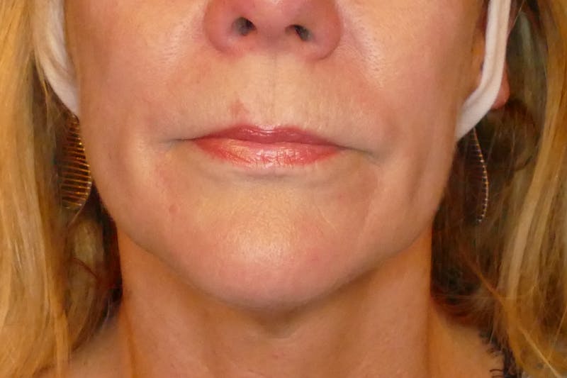 Laser Treatments Before & After Gallery - Patient 234290 - Image 6