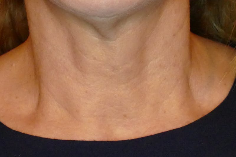 Laser Treatments Before & After Gallery - Patient 234290 - Image 7