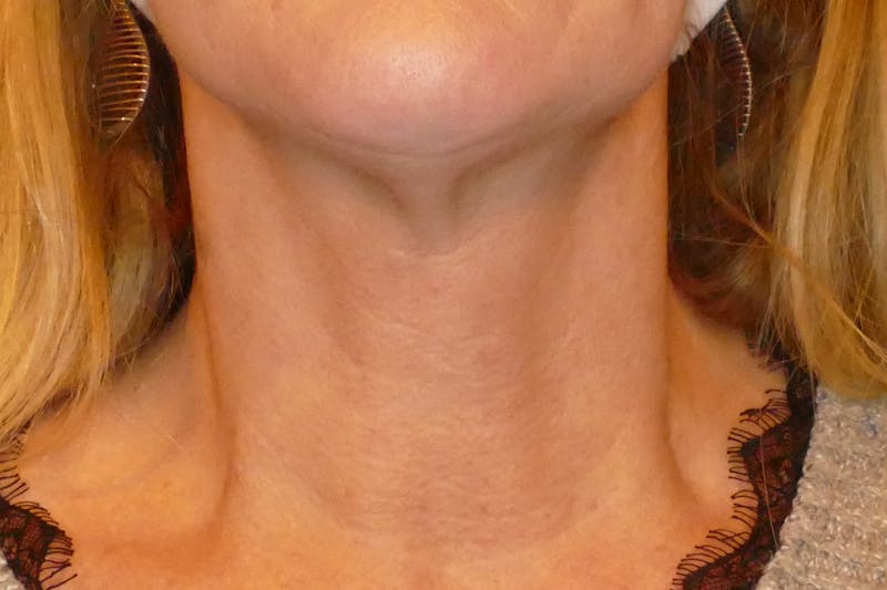 Laser Treatments Before & After Gallery - Patient 234290 - Image 8