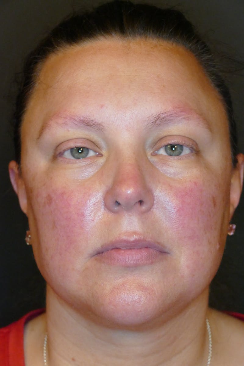 Laser Treatments Before & After Gallery - Patient 250495 - Image 1