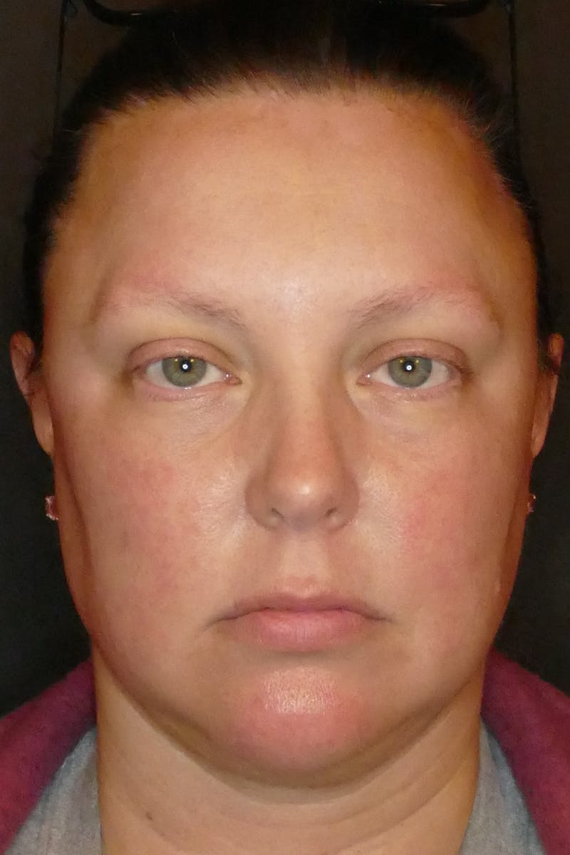 Laser Treatments Before & After Gallery - Patient 250495 - Image 2