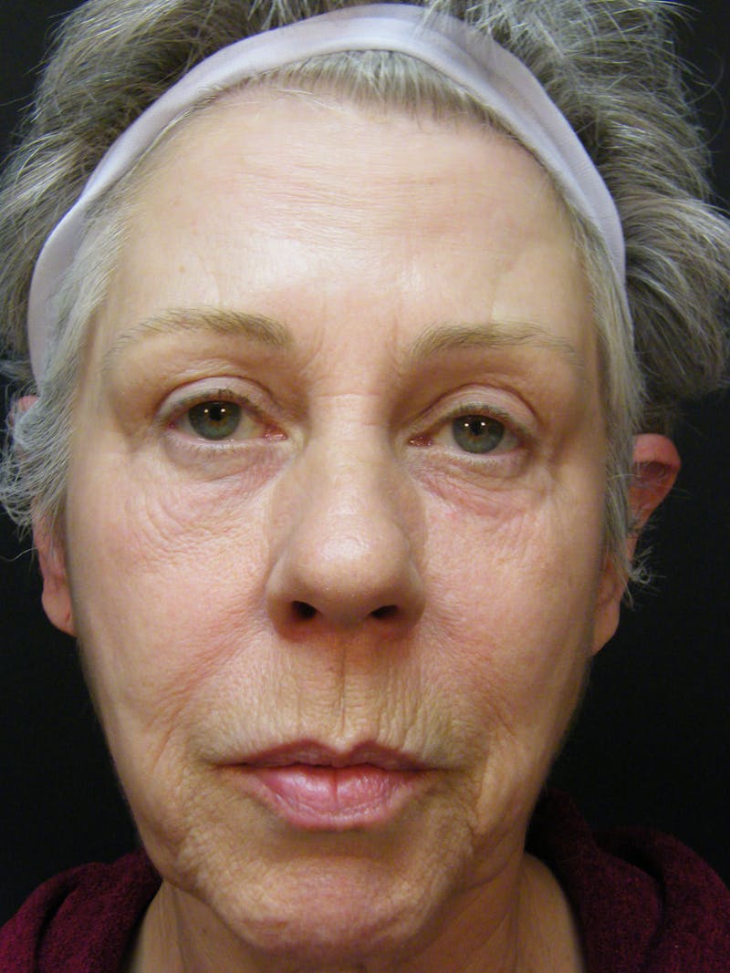 Laser Treatments Before & After Gallery - Patient 189107 - Image 1