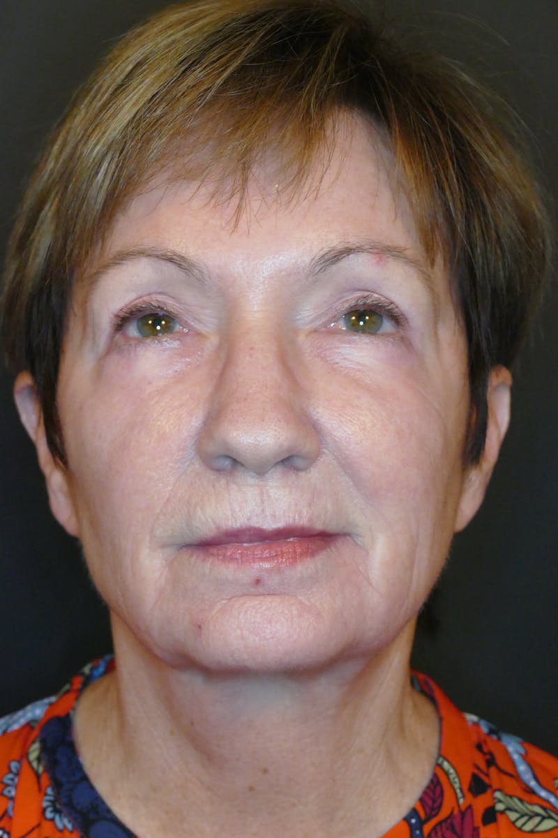 Laser Treatments Before & After Gallery - Patient 431074 - Image 1