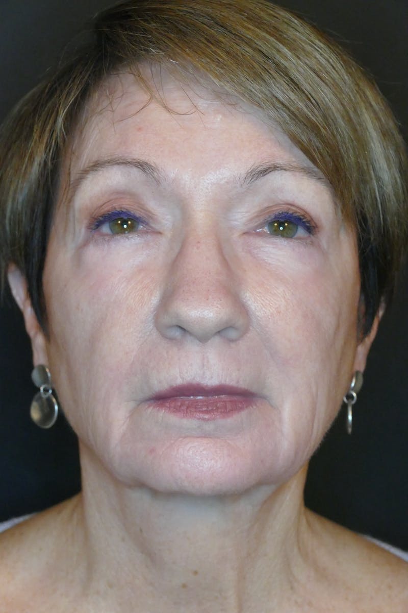Laser Treatments Before & After Gallery - Patient 431074 - Image 2