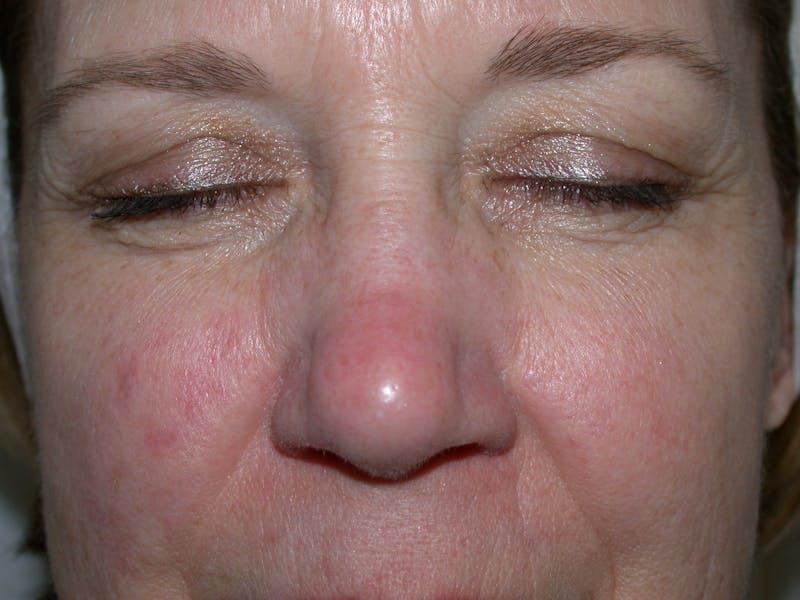 Photorejuvenation Before & After Gallery - Patient 266788 - Image 1