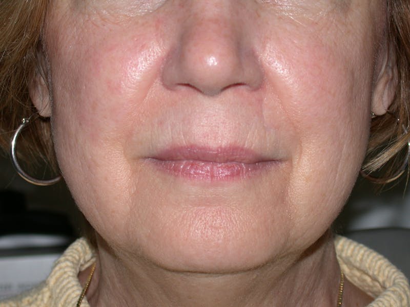 Photorejuvenation Before & After Gallery - Patient 266788 - Image 2
