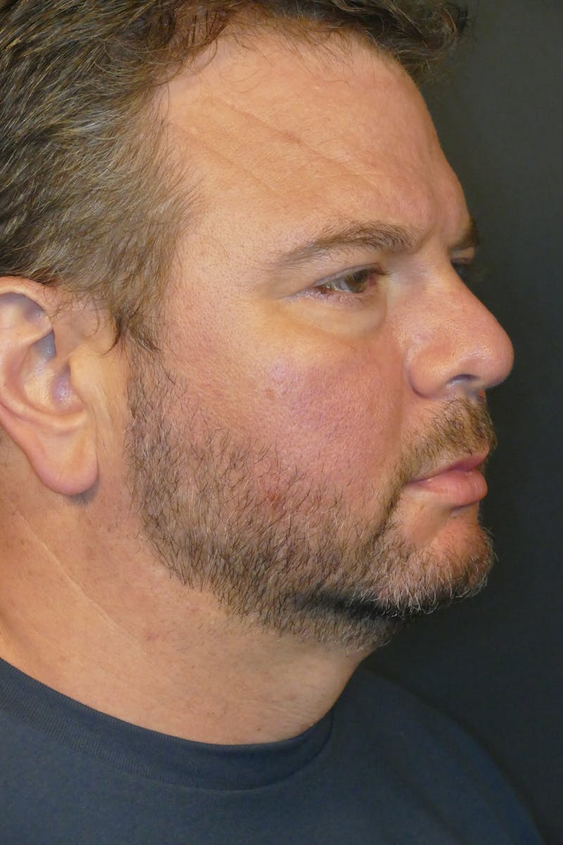 Photorejuvenation Before & After Gallery - Patient 414818 - Image 1