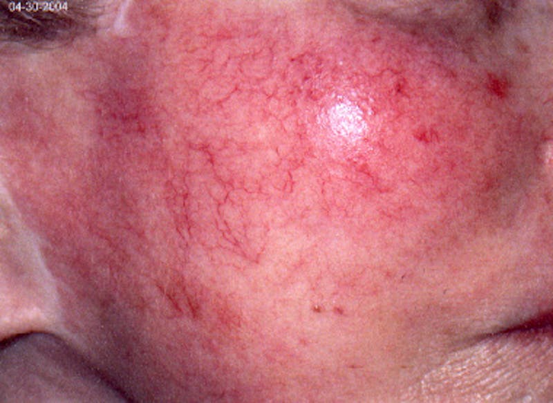 Photorejuvenation Before & After Gallery - Patient 345312 - Image 1