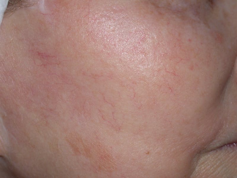 Photorejuvenation Before & After Gallery - Patient 345312 - Image 2