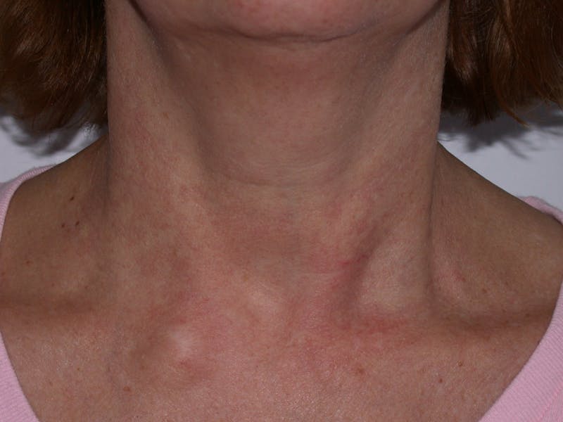 Photorejuvenation Before & After Gallery - Patient 430820 - Image 1