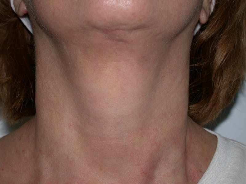 Photorejuvenation Before & After Gallery - Patient 430820 - Image 2