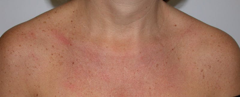Photorejuvenation Before & After Gallery - Patient 356582 - Image 1