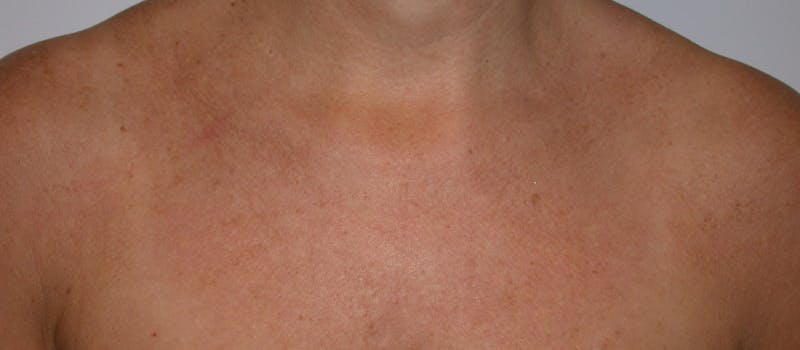 Photorejuvenation Before & After Gallery - Patient 356582 - Image 2
