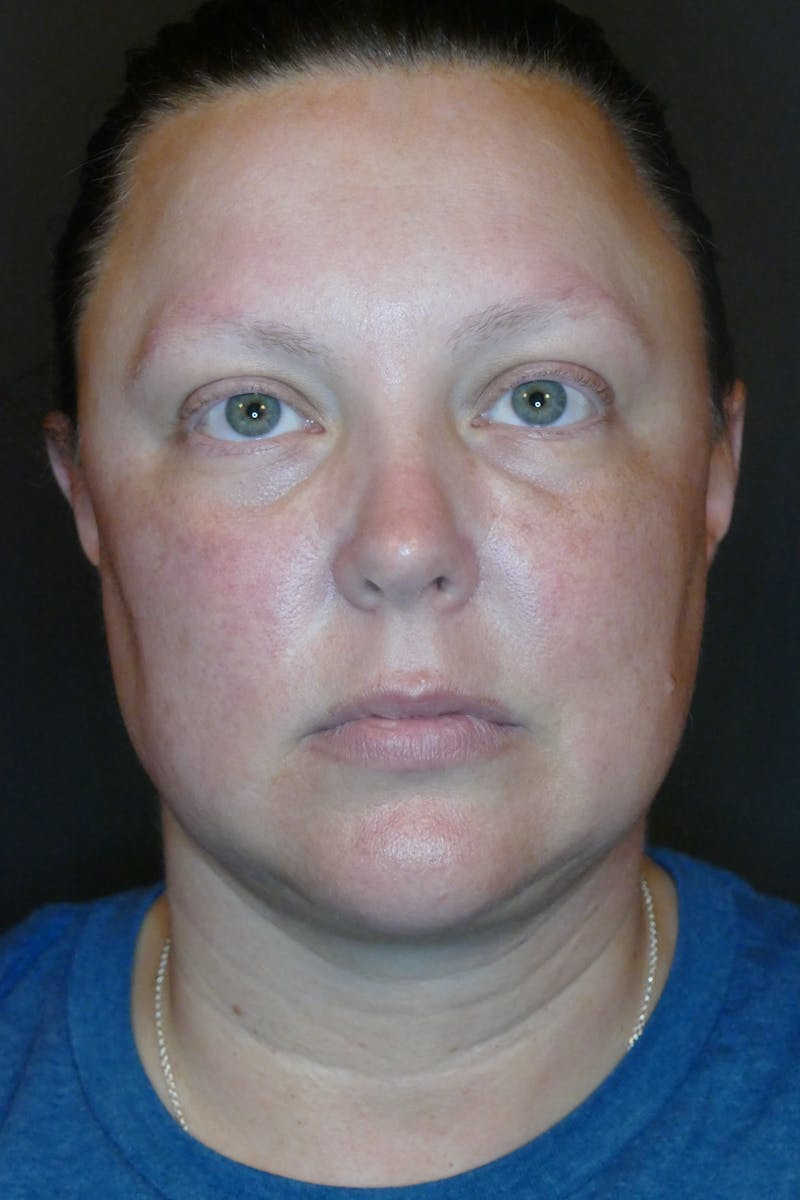 Kybella Before & After Gallery - Patient 687384 - Image 2