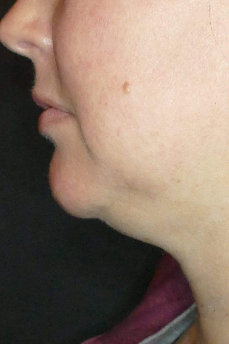 Kybella Before & After Gallery - Patient 687384 - Image 3