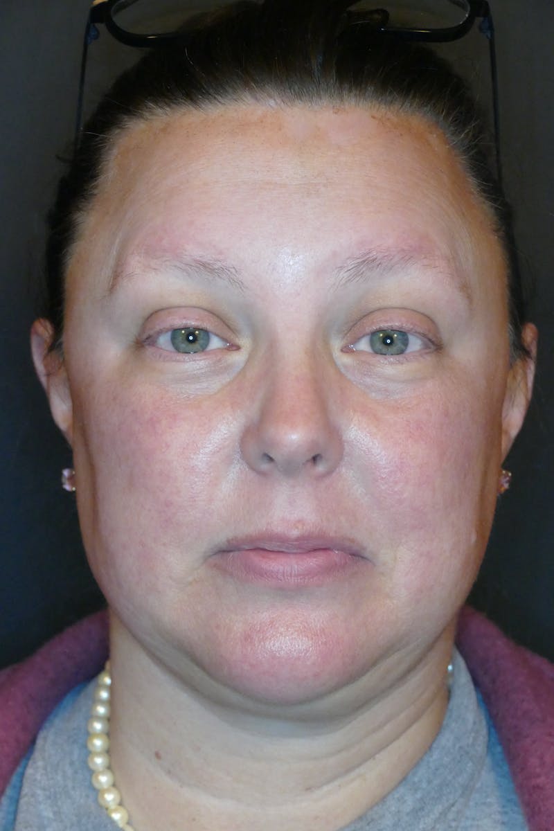 Kybella Before & After Gallery - Patient 687384 - Image 4