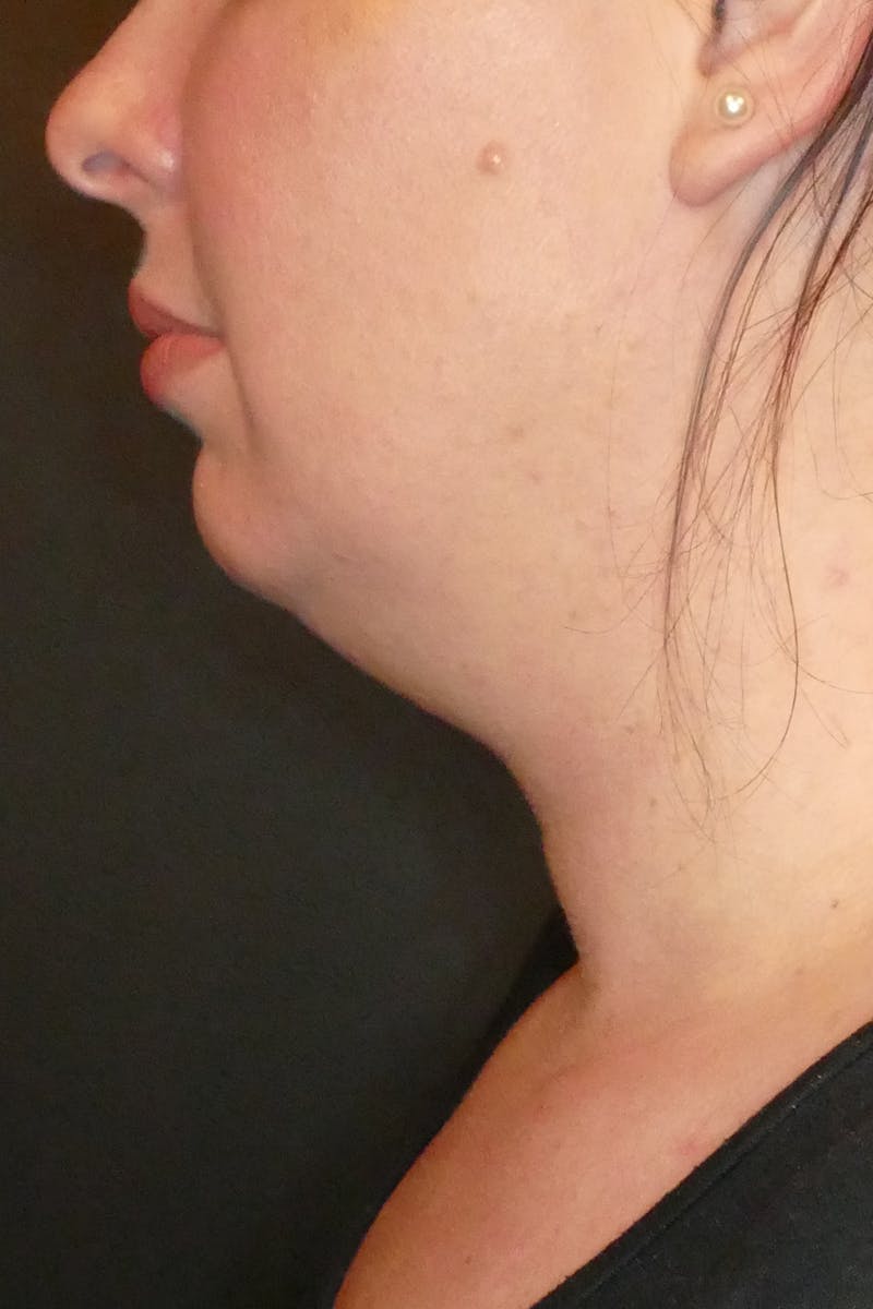 Kybella Before & After Gallery - Patient 112066 - Image 1