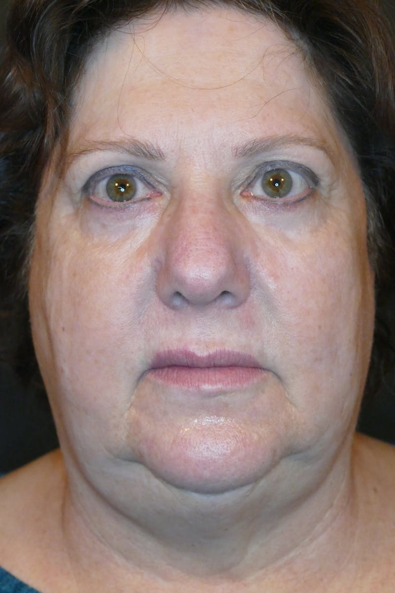 Kybella Before & After Gallery - Patient 360237 - Image 1