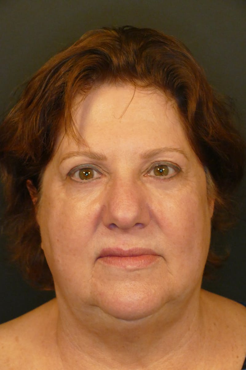 Kybella Before & After Gallery - Patient 360237 - Image 2