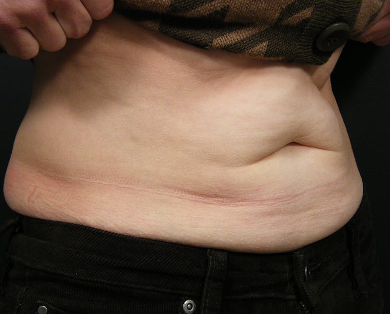 Body by Thermage Before & After Gallery - Patient 324535 - Image 1