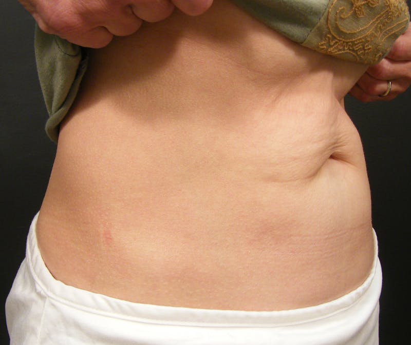 Body by Thermage Before & After Gallery - Patient 324535 - Image 2